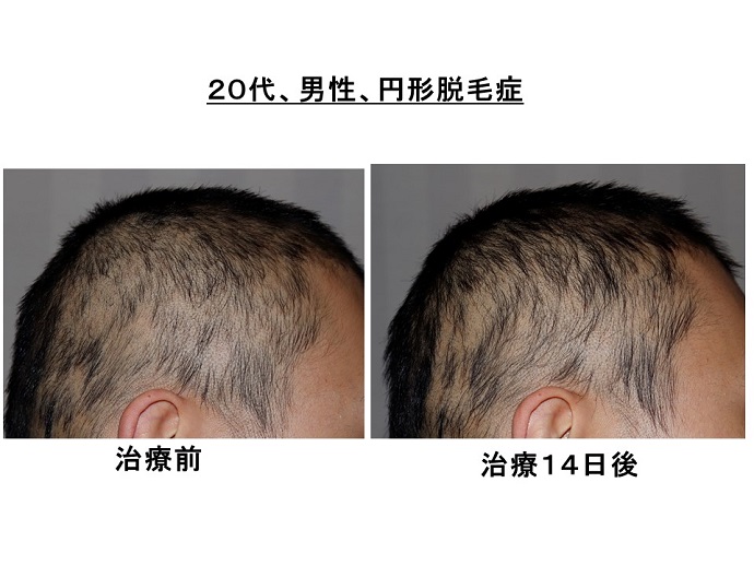円形脱毛症　病院